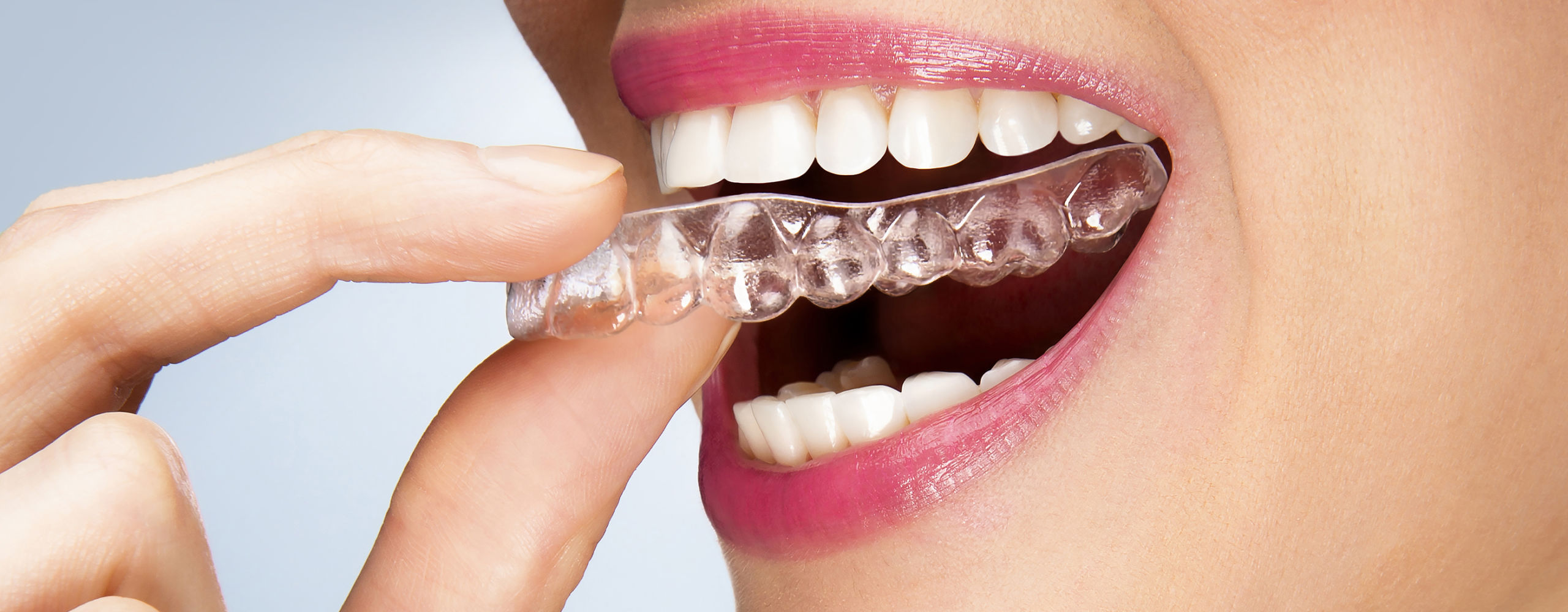Suresmile open dag Woerden SureSmile